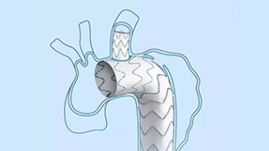 多分支人工血管覆膜支架系统（华脉泰科）
